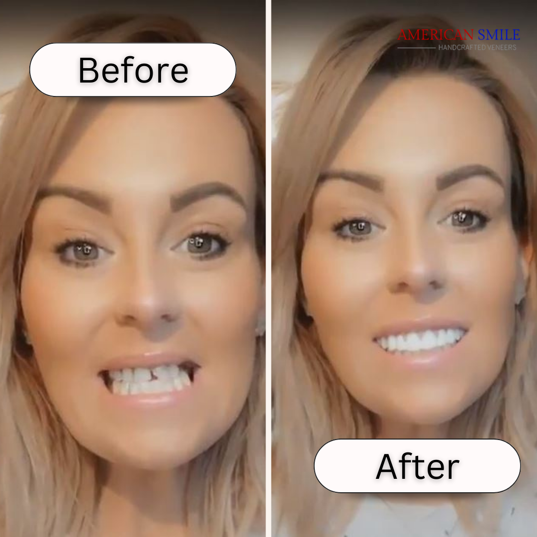 Great Smile Veneer - Limited BOGO Deal