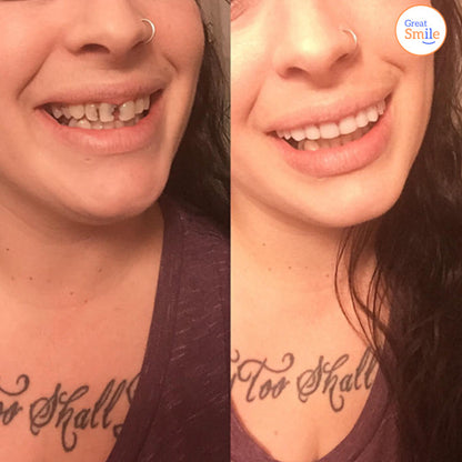 Great Smile Veneer (Upper & Lower) - great-smile-veneer-upper-lower