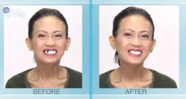 Multi-Shade Temporary Tooth Replacement Kit - mutli-shade-temporary-tooth-replacement-kit