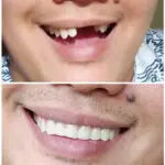 New! – Natural Shade – Instant Smile Comfort Fit Flex - new-natural-shade-instant-smile-comfort-fit-flex