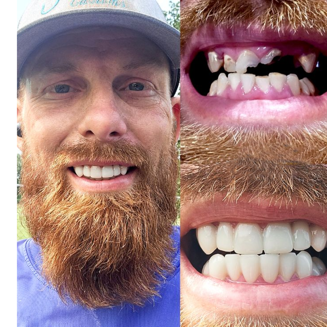 Instant Smile Comfort Fit Flex (Authentic Instant Smile)