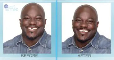 Multi-Shade Temporary Tooth Replacement Kit - mutli-shade-temporary-tooth-replacement-kit