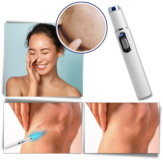 LumaGlow™ Dark Spot Remover Pen - Blue Light Laser Treatment for Skin Blemishes